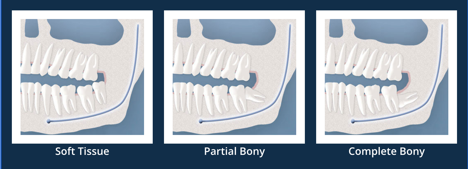 Three images of a skull showing different types of bone.