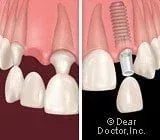 A before and after picture of a dental implant in a person 's teeth.