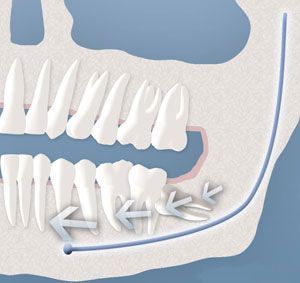 tooth crowding