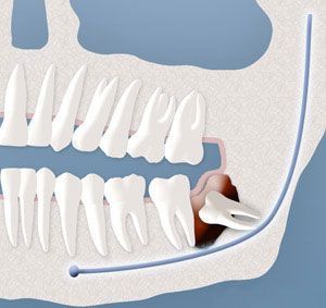 A close up of a person 's teeth with a tooth missing.