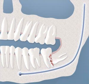 damage to adjacent teeth