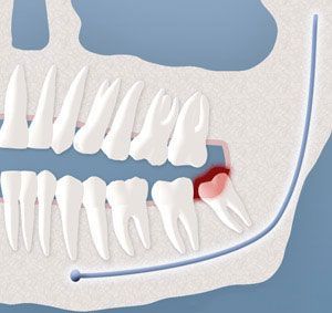 A close up of a person 's teeth with a tooth missing.