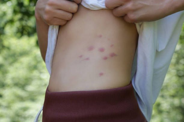 A person pulls up their shirt to reveal a cluster of red, raised skin bumps on their side, likely insect bites.