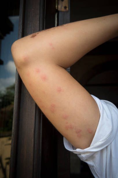 Arm with multiple red, raised skin bumps, possibly insect bites. The person is wearing a white shirt.
