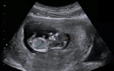 An ultrasound of a baby in the womb of a woman.