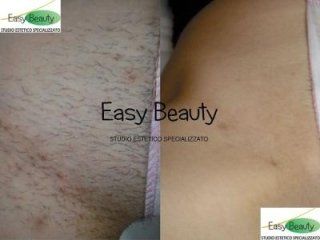 Effetti di epilazione a laser