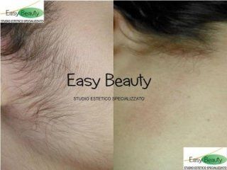 Effetti di epilazione a laser su basette