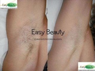 Effetti di epilazione a laser su ascella