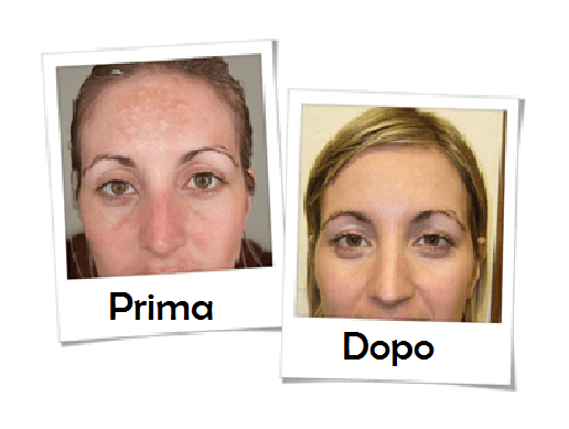 Effetti di microdermoabrasione su ragazza bionda