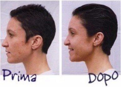 Effetti di microdermoabrasione su ragazza mora