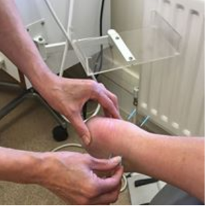 LOWER LIMB ACUPUNCTURE