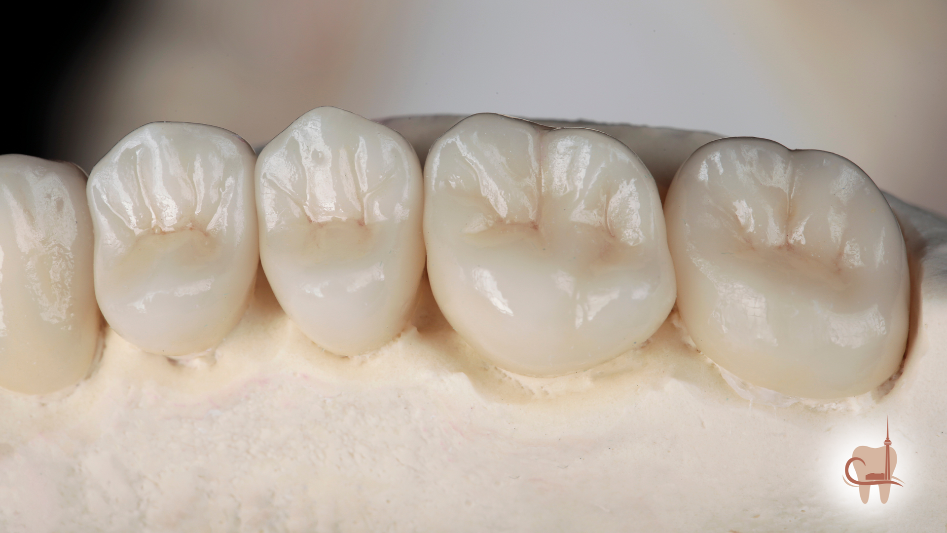 Four porcelain dental crowns on a model, shades of white and beige, with detailed ridges and textures.