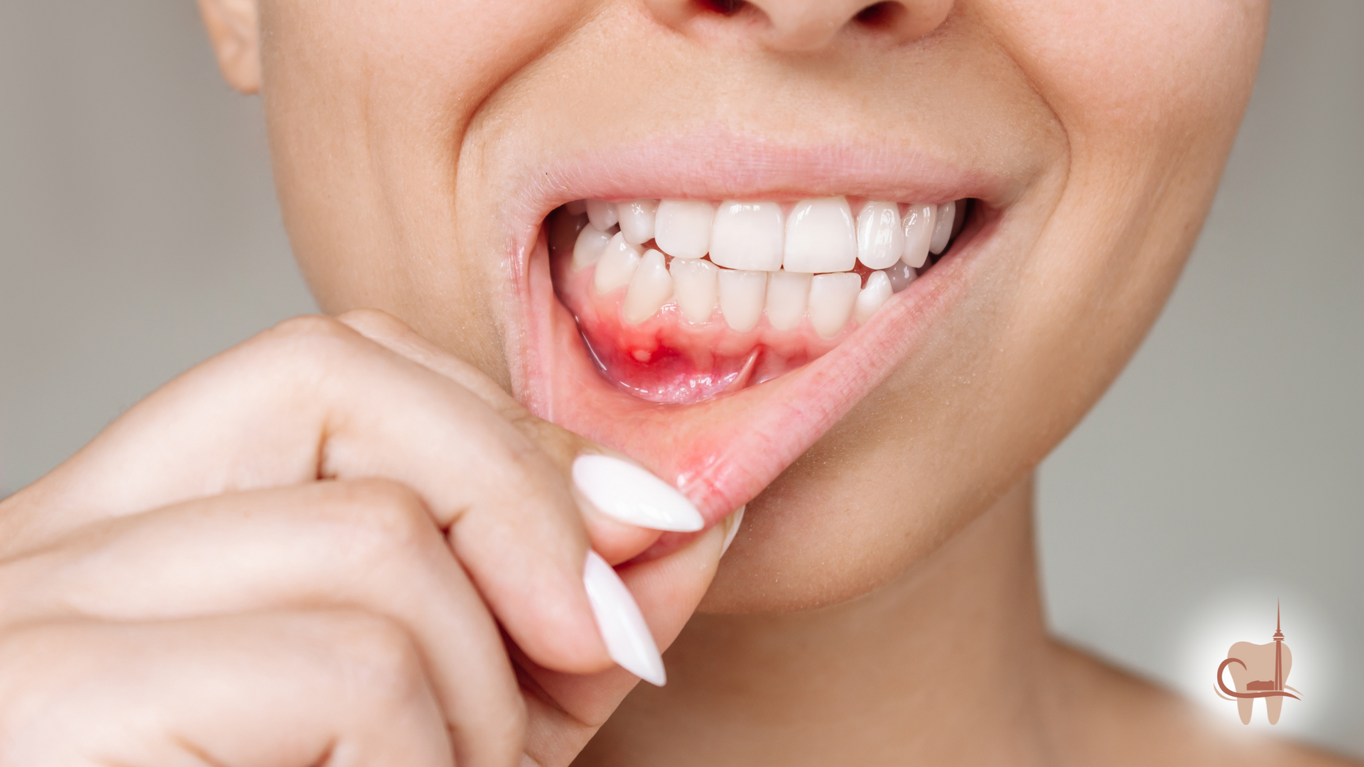 Woman pulling lip down to reveal inflamed gums.