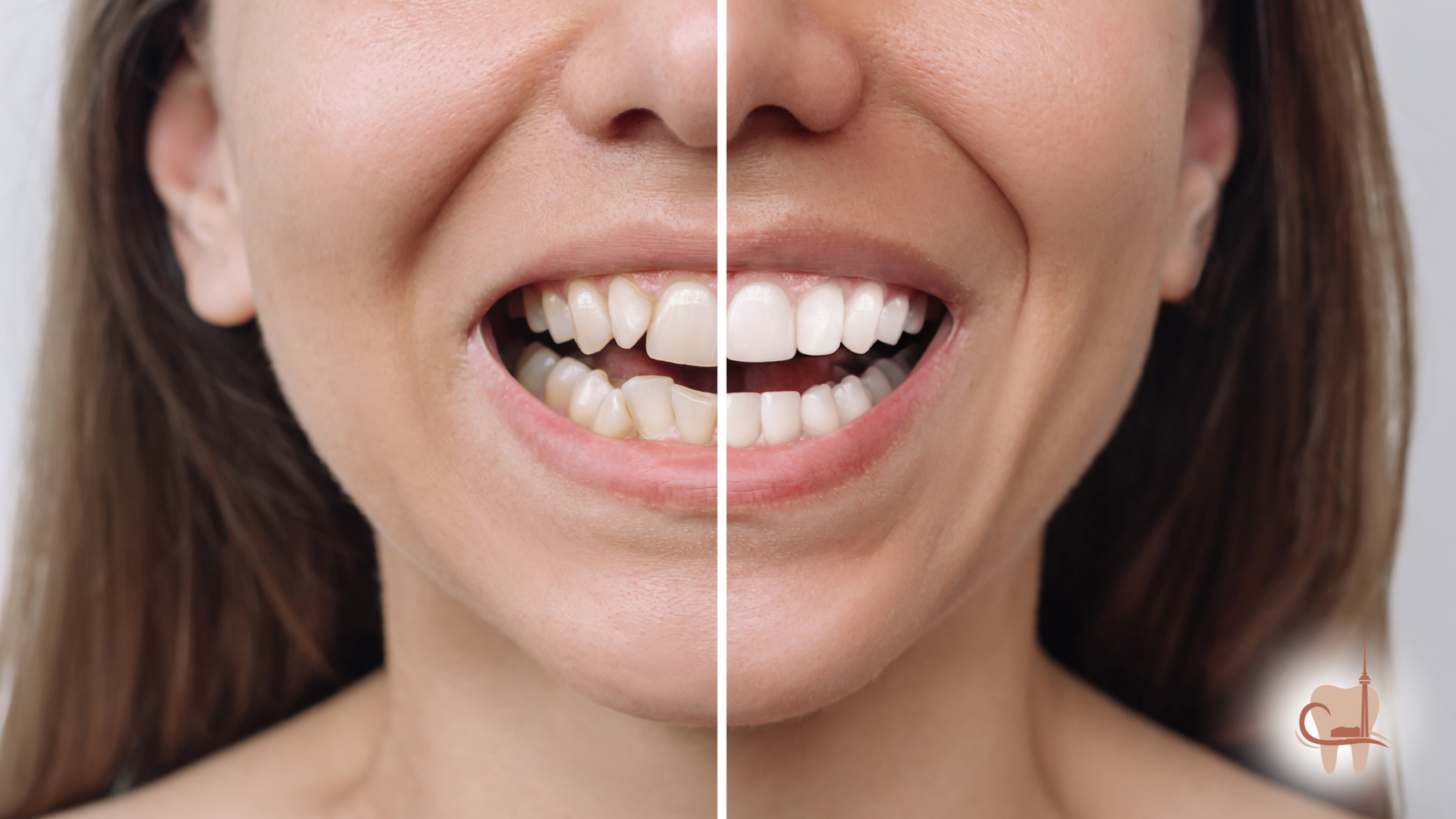 Split-screen: Woman's teeth before and after cosmetic dental work. Whiter, aligned teeth on the right.