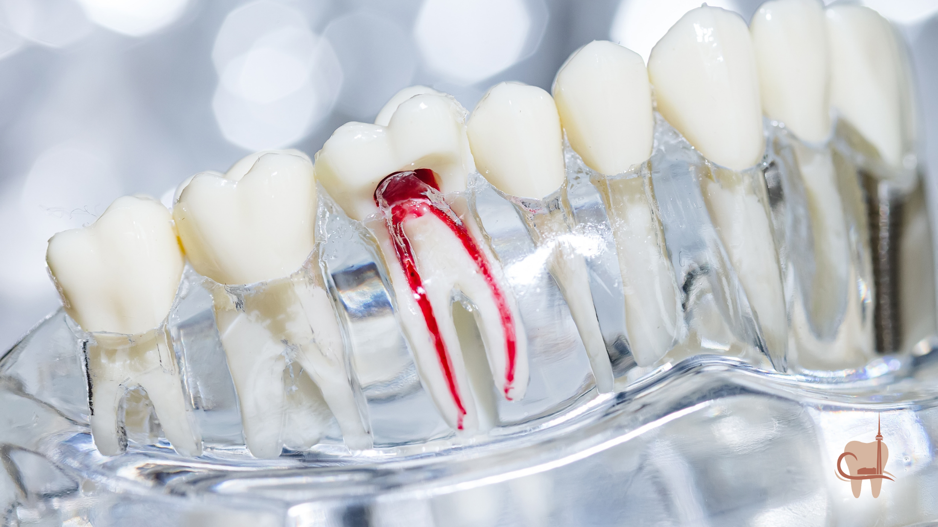 Model of teeth, with one showing exposed root canals in red.