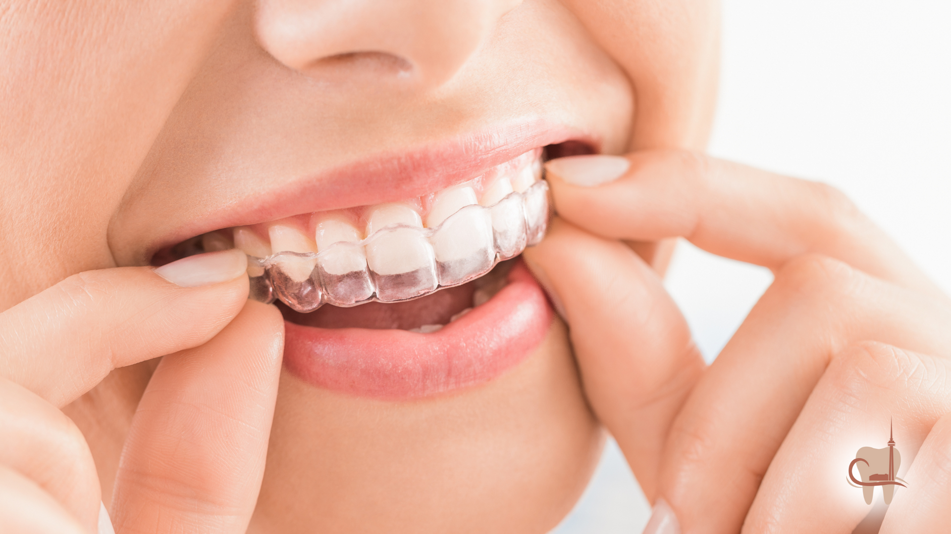 Woman inserting clear dental aligner into mouth.