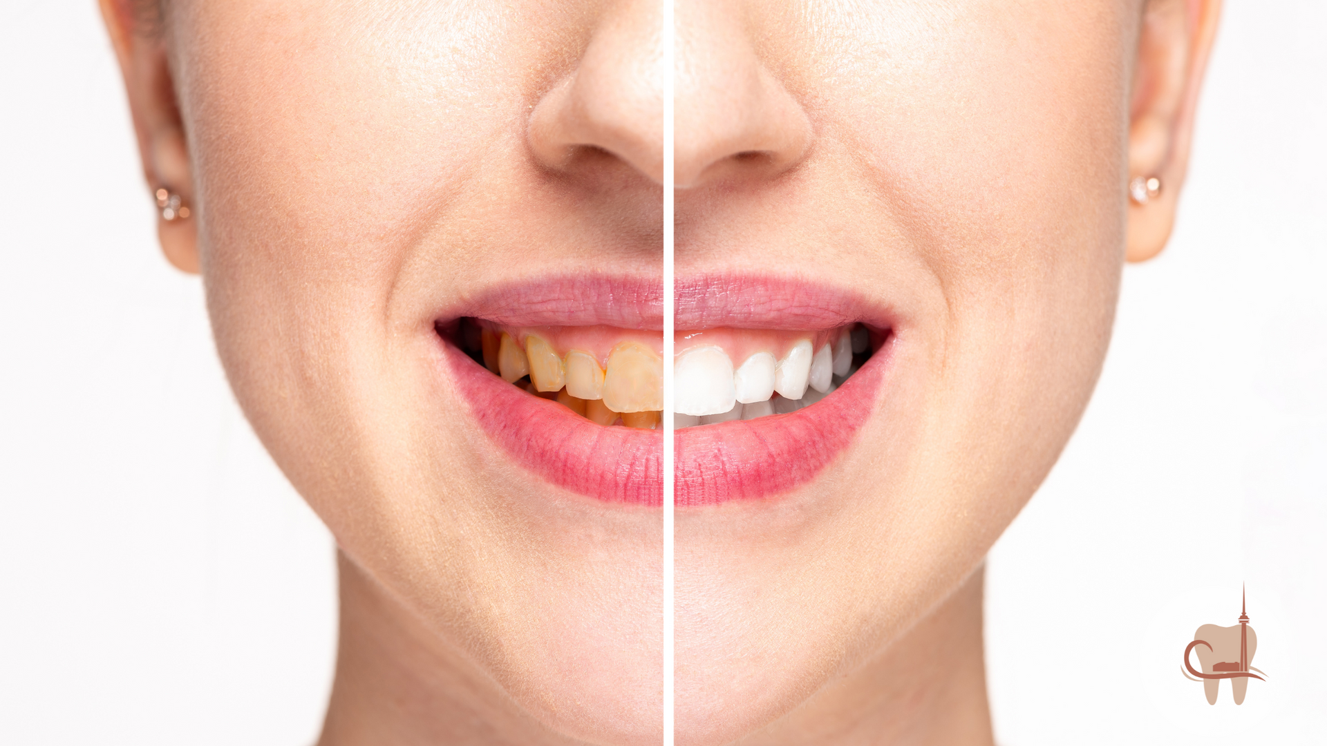 Woman's smile, half showing yellow teeth, half showing whitened teeth, side-by-side comparison.