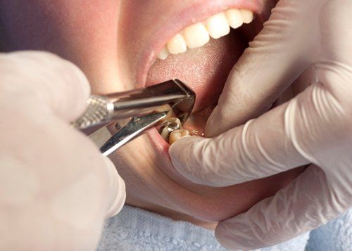 Dental Extraction — Patient Having Is Tooth in Jasper, IN