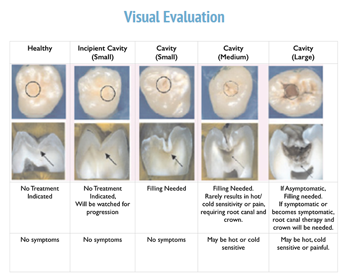 Surface-Level Cavities 101: What They Are & How They're Treated