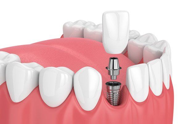 Diagram of dental implant.