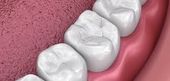 Teeth with tooth colored dental fillings  | Topeka KS