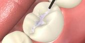 Tooth with dental sealant on it | Preventative dentist near me in Topeka KS