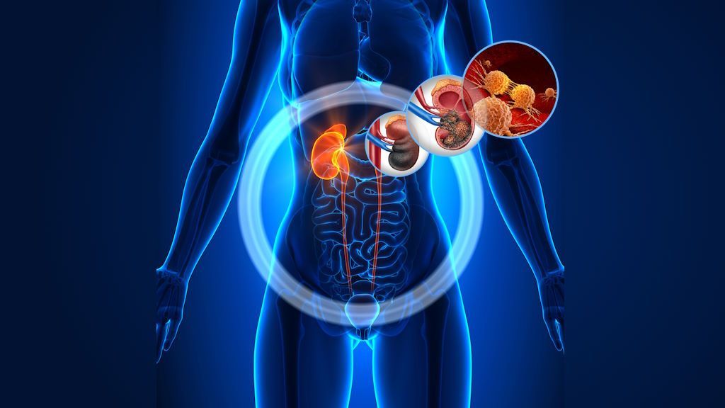 Cáncer de Riñón: Síntomas Clave a los que se Deben Prestar Atención