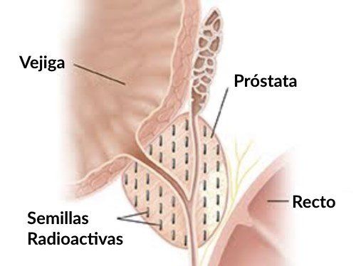 Semillas radioactivas en la próstata