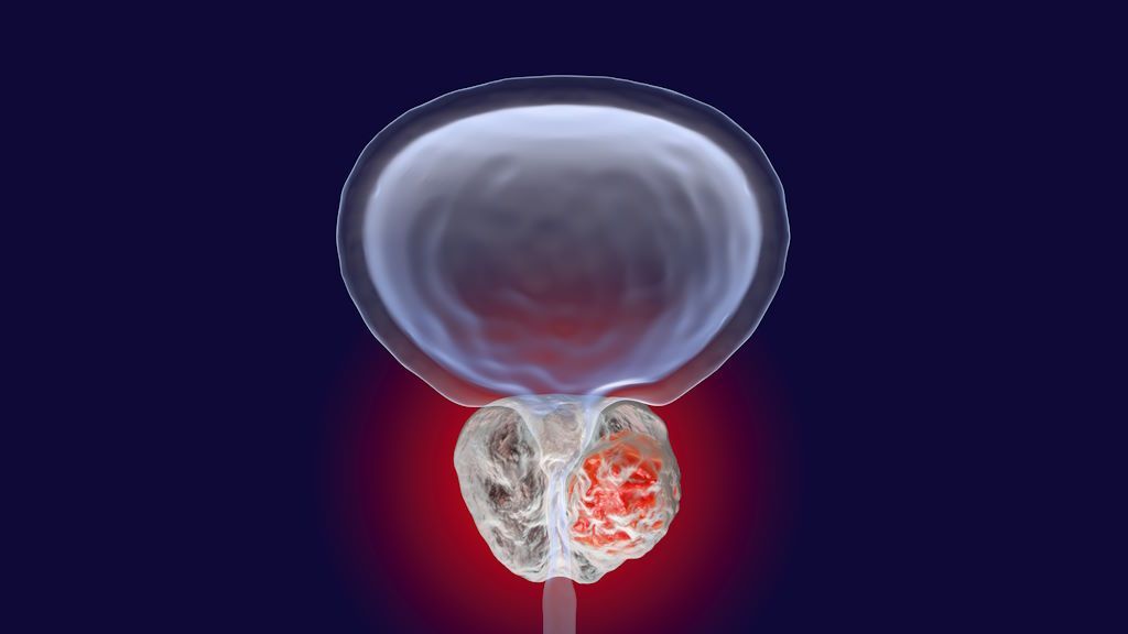 Diagnóstico del cáncer de próstata