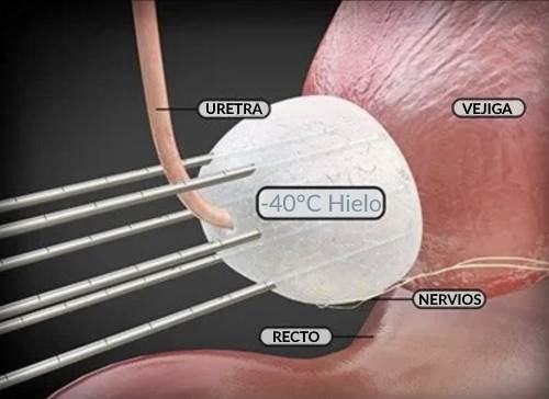 Crioterapia