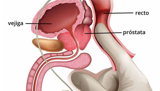 tacto rectal cáncer de próstata biopsie prostata