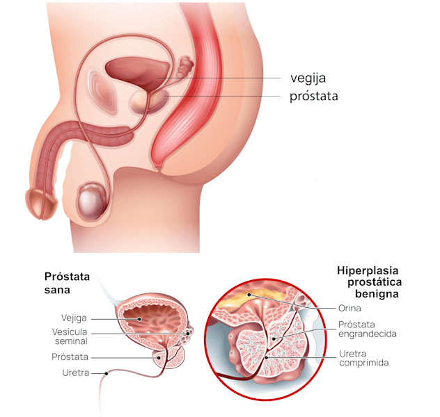 Hiperplasia benigna de la próstata