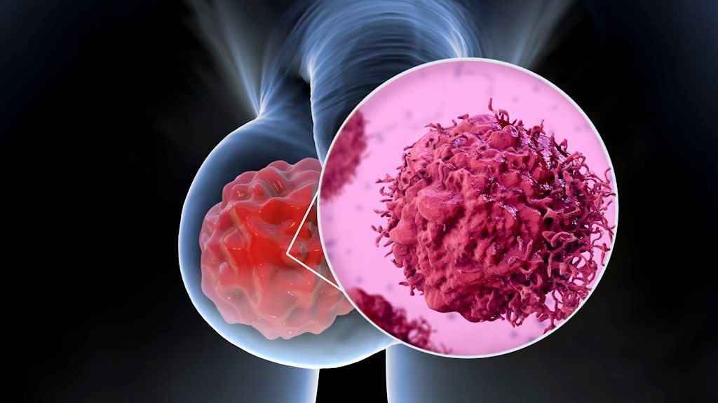 Síntomas del Cáncer de Testículo