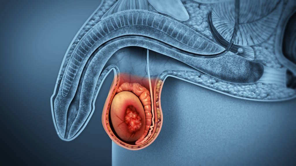 Tipos de cáncer de testículo