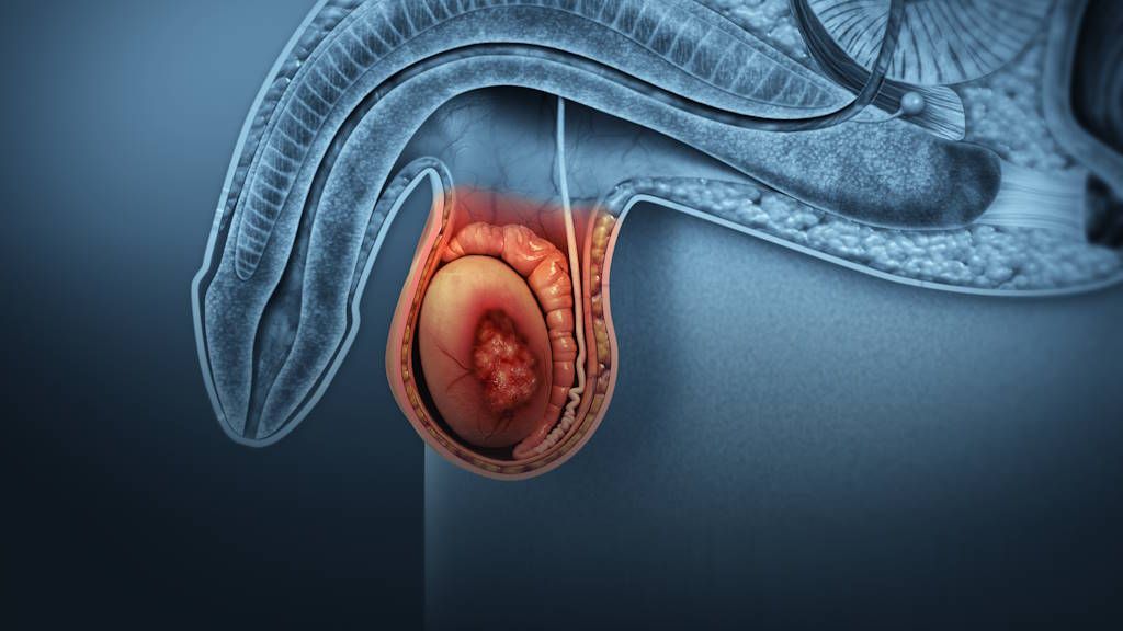 Entendiendo los diferentes tipos de cáncer de testículo