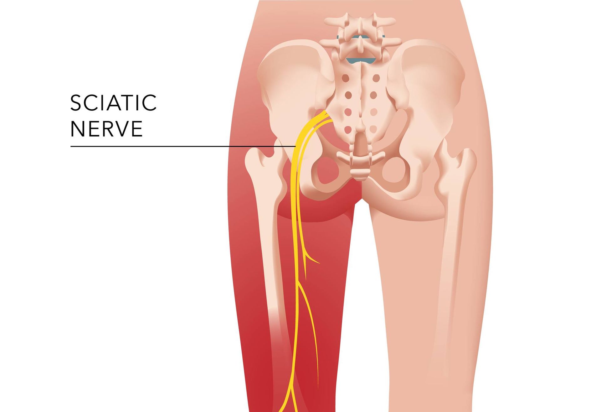 Sciatica Treatment