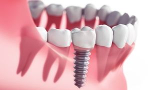 Periodontist — Dental implantation in Lexington, KY