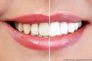 Das Bleaching hält zwei bis fünf Jahre und kann einfach wiederholte werden. Das Bleaching hält zwei bis fünf Jahre und kann einfach wiederholte werden.