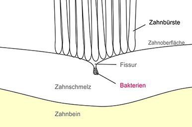 Schematische Darstellung der Fissuren Schematische Darstellung der Fissuren