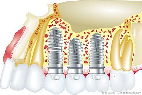 Zahnimplantate Rudersberg