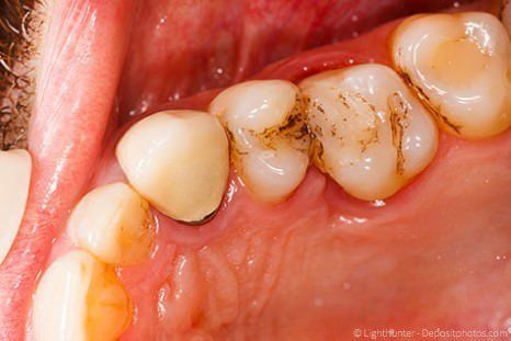 Einfache Kunststoff-Füllungen halten nicht lange, verfärben sich und bilden Randspalten.