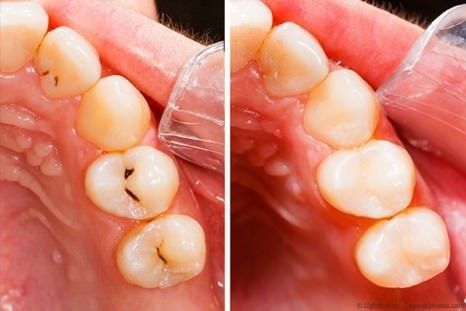 Komposit-Füllungen sind eine gute Alternative zu Amalgam und einfachem Kunststoff.