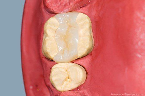 Keramik-Inlay mit natürlichen Zahnfarben auf dem Gipsmodell. Keramik-Inlay mit natürlichen Zahnfarben auf dem Gipsmodell.