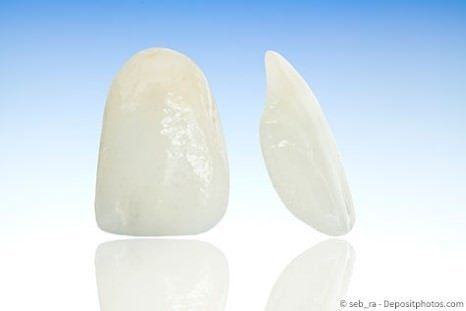 Veneers - hauchdünne Verblendschalen für schöne Zähne Veneers - hauchdünne Verblendschalen für schöne Zähne