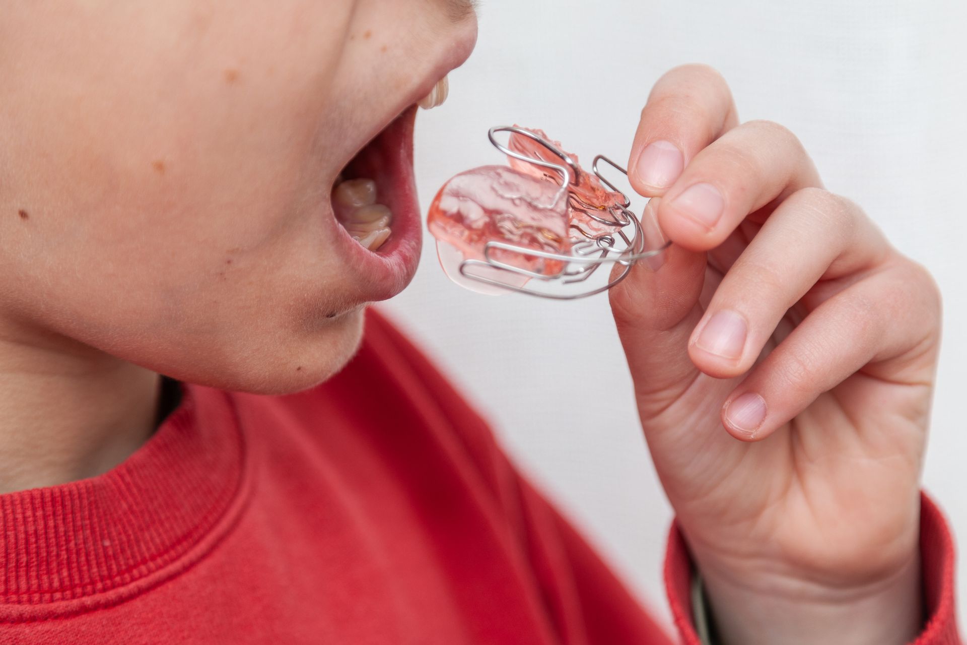 A child is wearing a retainer in his mouth.