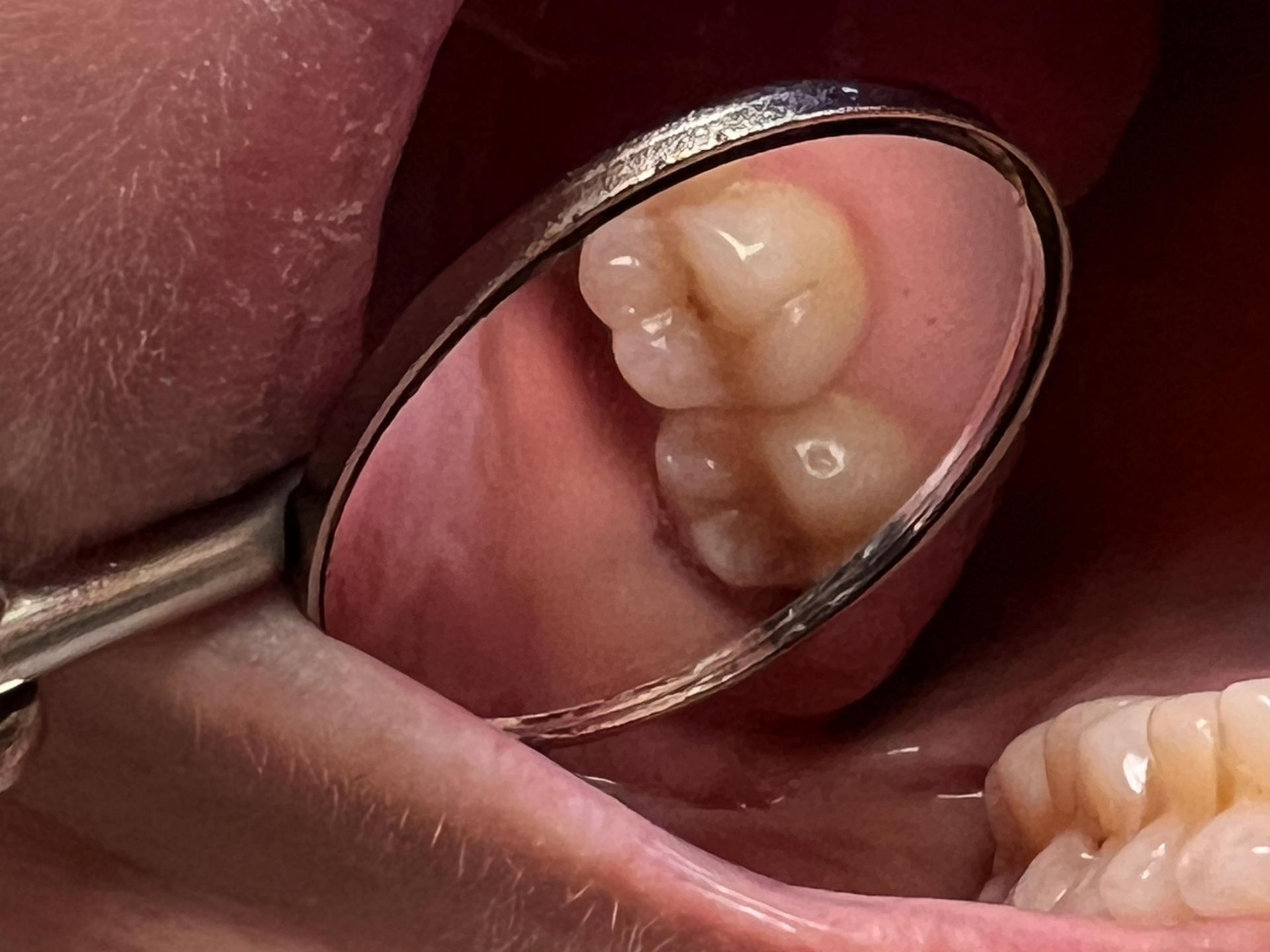 A close up of a person 's teeth with a dental mirror.