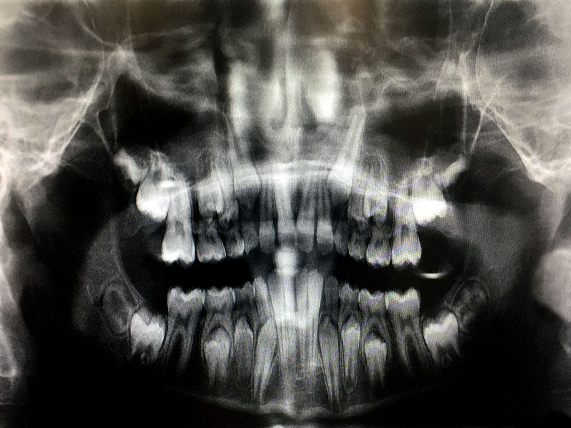 A black and white x-ray of a person 's teeth.