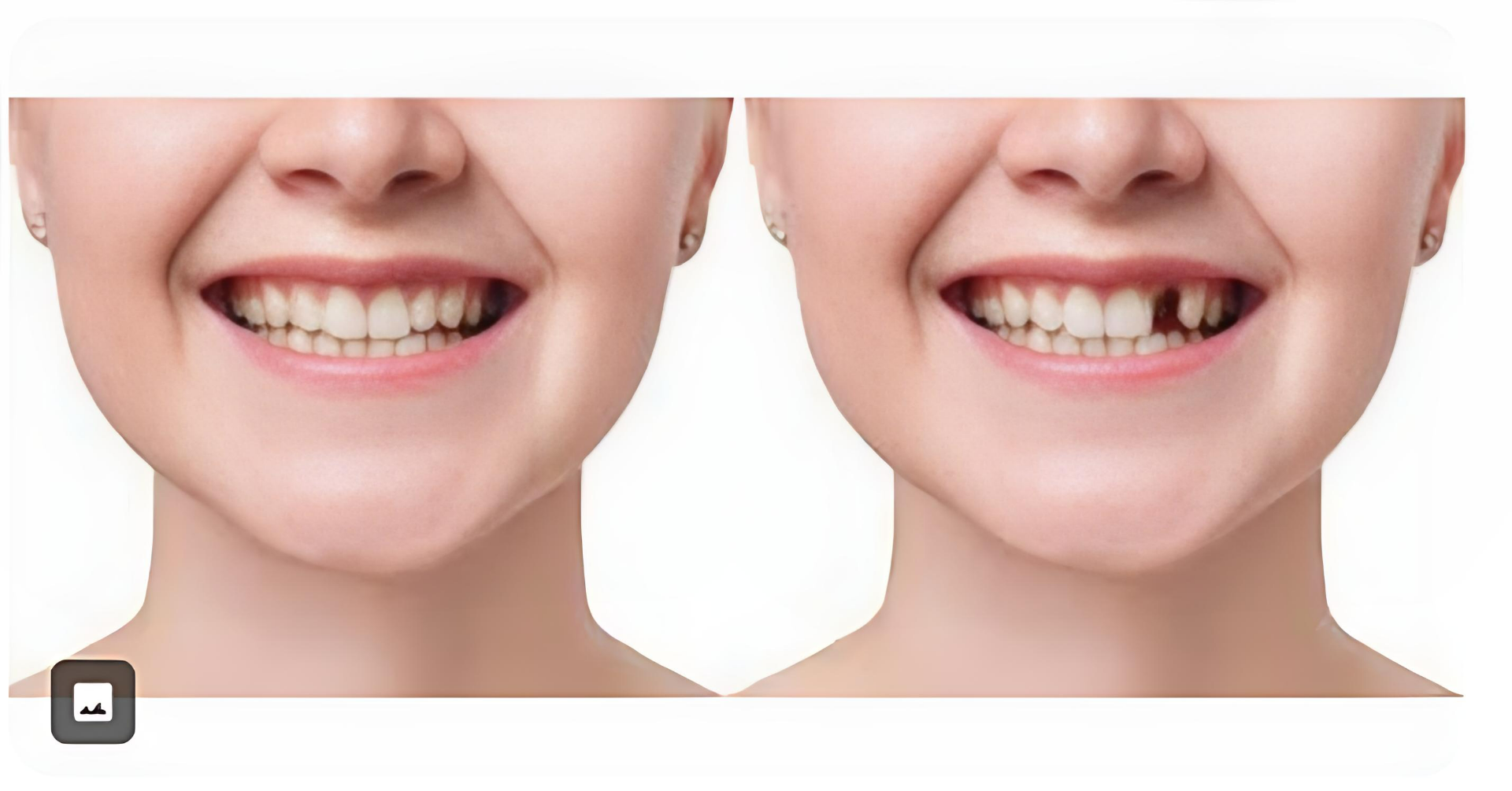 Side-by-side comparison of a person smiling with and without a tooth in their mouth.