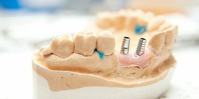 Dental Implants — Quincy, MI — Family Dental Home