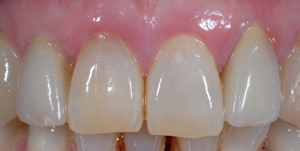 faccette in ceramica dentista odontoiatra milano